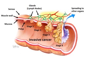 adenoma-carcinoma-sequence_e