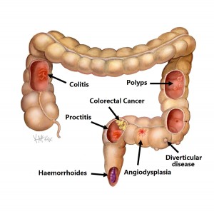 causes-of-rectal-bleeding_e