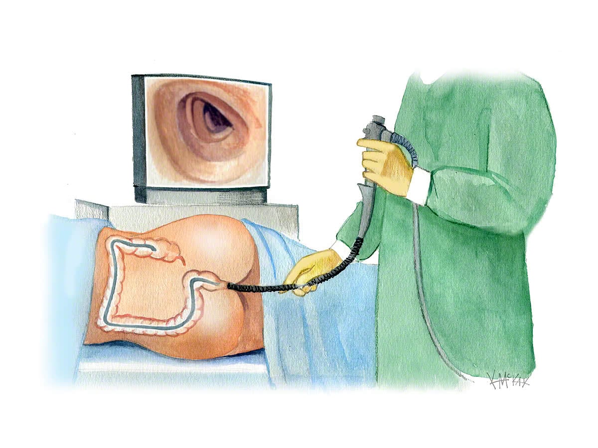 Colonoscopy – Endoscopy Online