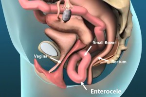 enterocele_e
