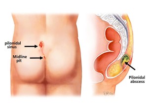 a, b, c. A. Marking of the incision containing the pilonidal cyst and 2