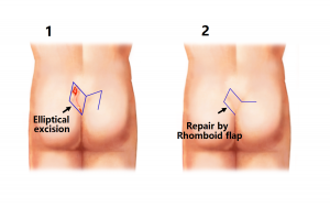 pilonidal sinus surgery