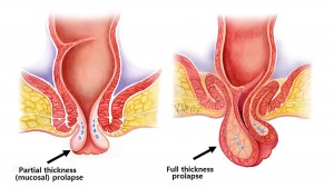 rectal-prolapse_e