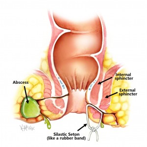 seton-repair-of-fistula_e