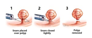 snared-polypectomy_e