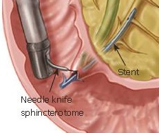 This image has an empty alt attribute; its file name is ERCP.jpg